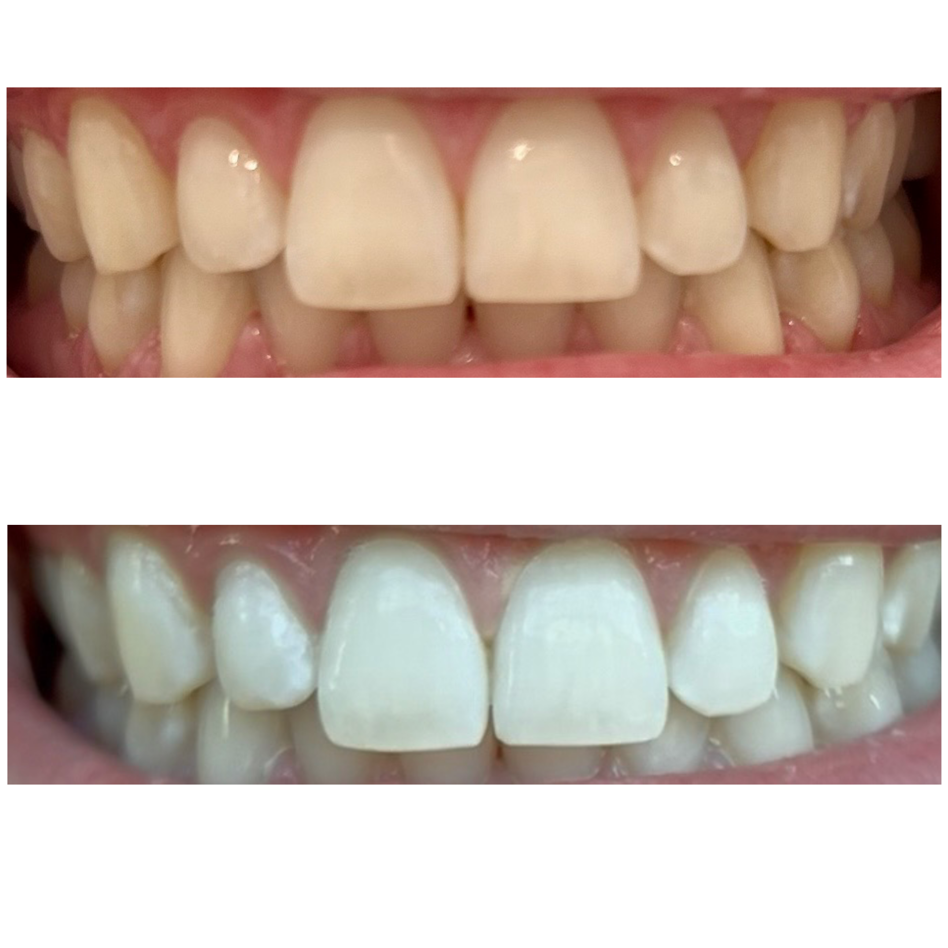 Before and after teeth whitening shade comparison showing significant improvement