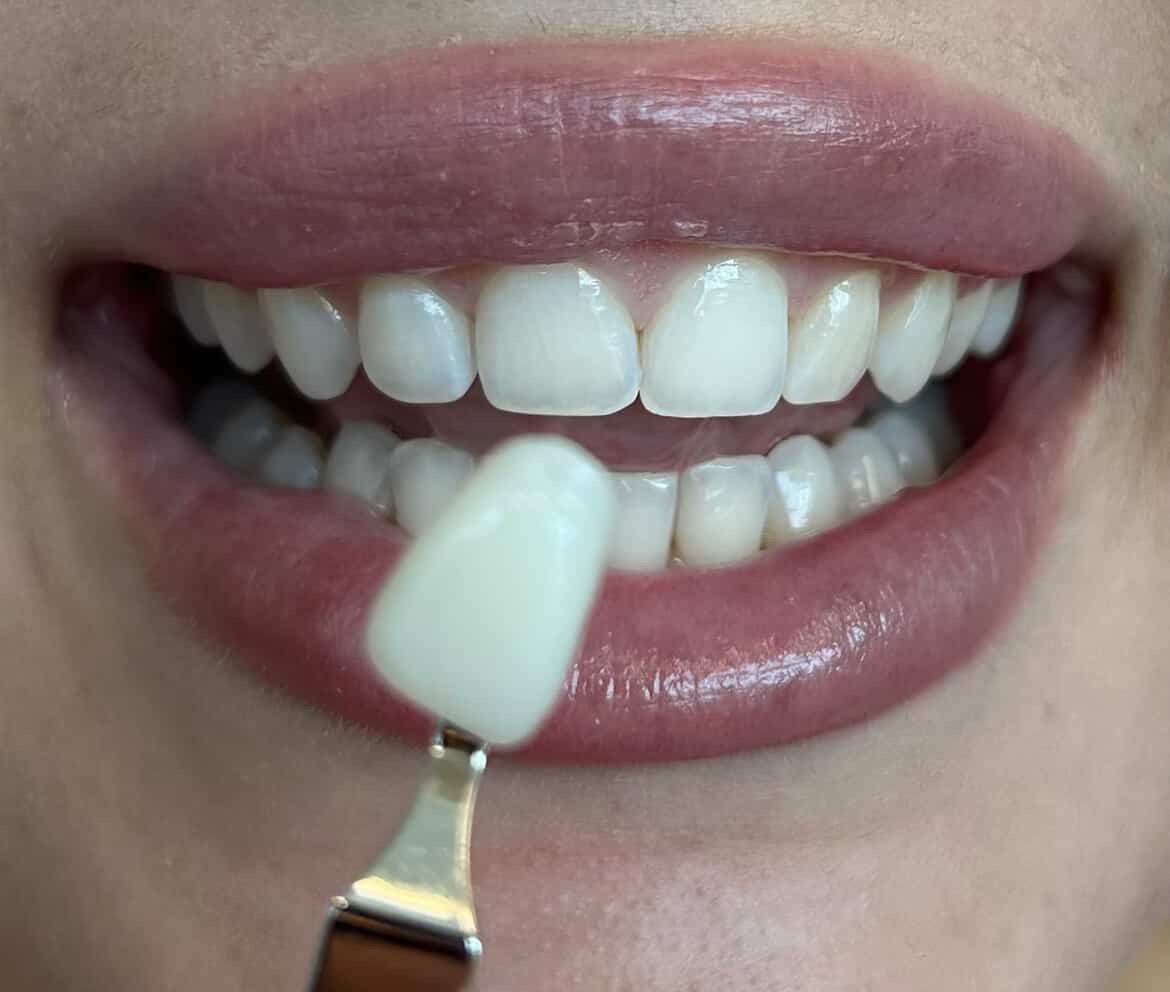 Professional shade guide held next to bright white teeth after whitening treatment
