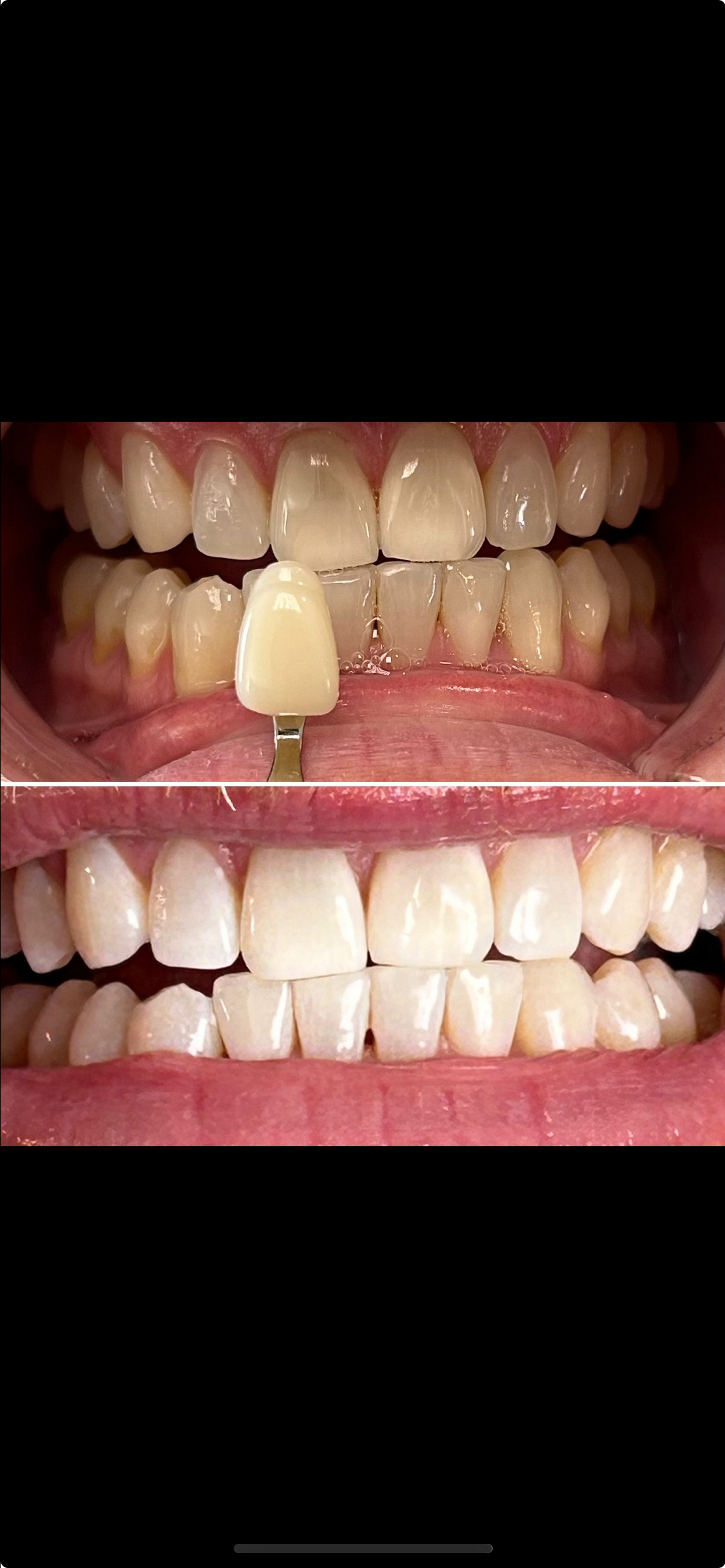 Before and after teeth whitening comparison showing dramatic improvement in shade